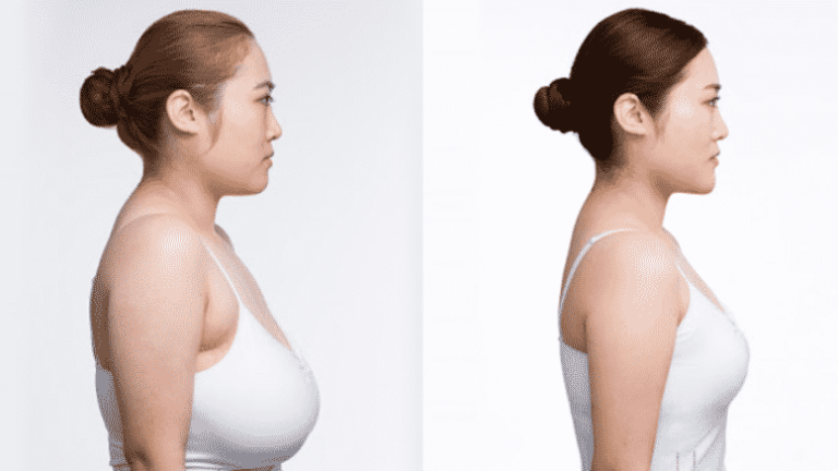 How To Get A Breast Reduction Covered By Insurance