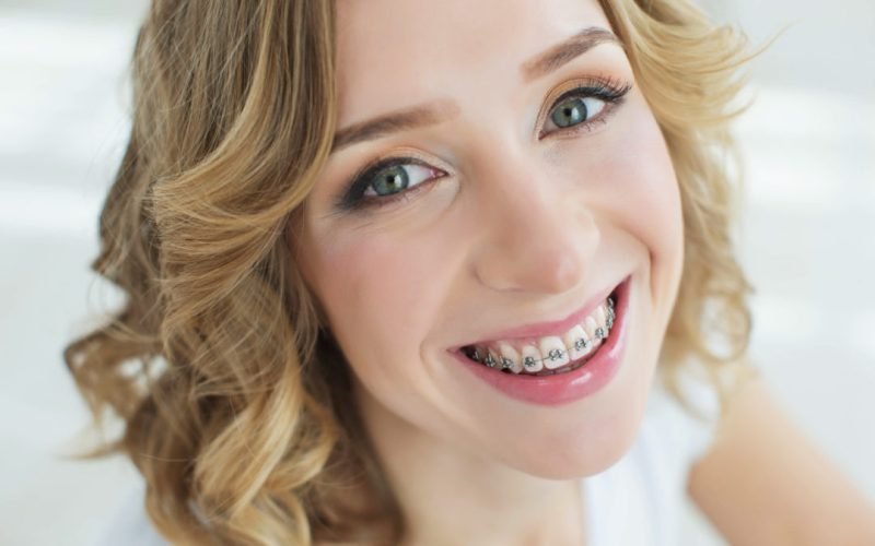 How To Get Braces Covered By Medical Insurance