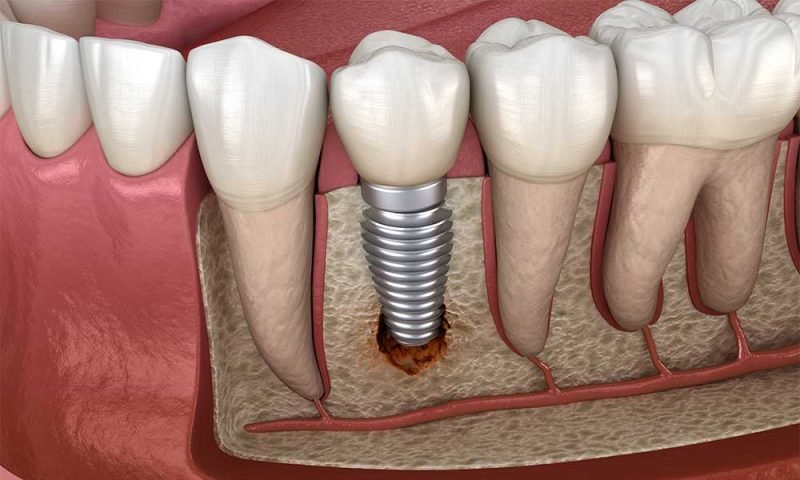 How To Get Dental Implants Covered By Insurance
