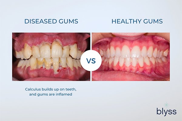 Can You Make Payments on Dental Implants