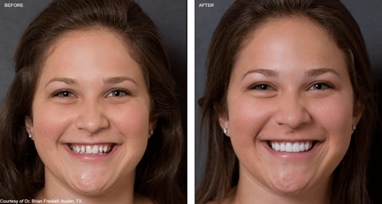Können Sie Zahlungen für Veneers leisten?